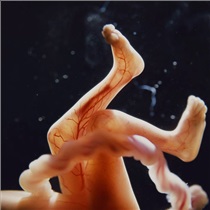 از بین رفتن ورم سینه و تهوع علامتی برای سقط جنین