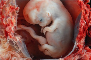 چگونه می‌توان قانونی سقط جنین کرد؟