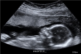 تصویربرداری با اشعهٔ ایکس در حاملگی عموماً بی‌خطر است