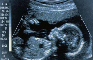 دلایل انجام سونوگرافی در 3 ماه اول و سوم بارداری