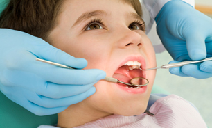  سیلانت راهکاری برای تقویت دندان کودکتان