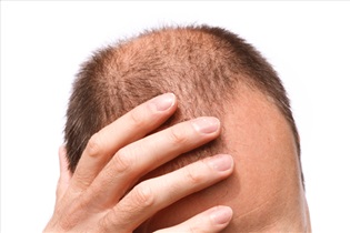 دلایل اصلی ریزش مو چیست؟