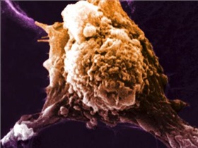 مقاوم شدن سرطان سینه با آزمایش خون