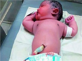 مادر دیابتی نوزاد ۶ کیلوگرمی به دنیا آورد /شگفتی پزشکان هند 