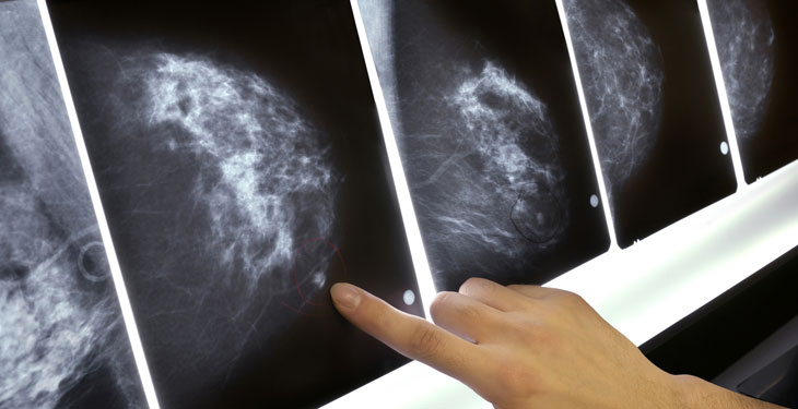 چند دلیل مهم برای انجام تست غربالگری سرطان سینه