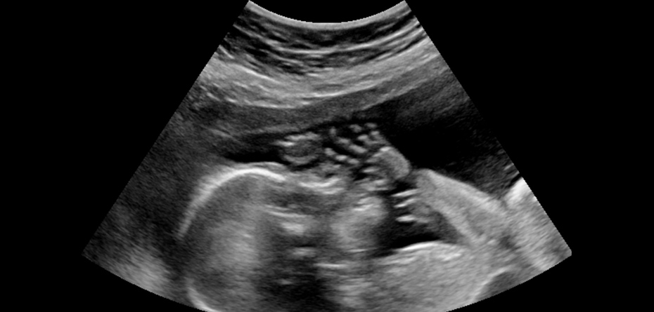 با سونوگرافی از سلامت قلب جنین مطمئن شوید