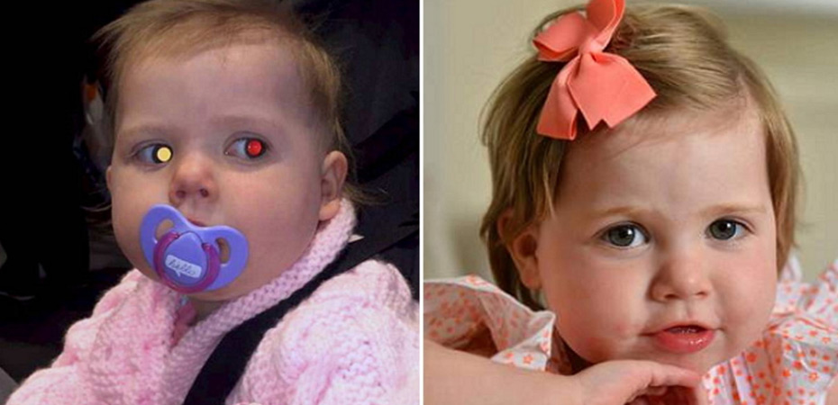 عکاسی که چشم دختر 7 ماهه را نجات داد