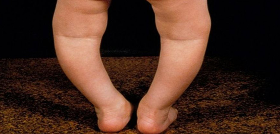 بهترین زمان برای درمان پاهای پرانتزی چند سالگی است؟