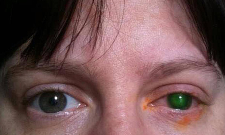 یک مادر 39 ساله که برای تعطیلات به اسکاتلند رفته بود، بعد از شنا در استخر هتل با لنز در چشمهایش، تقریبا بینایی خود را از دست داد و نابینا شد!