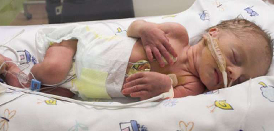 تولد نوزادان با روده خارج از بدن در آمریکا!
